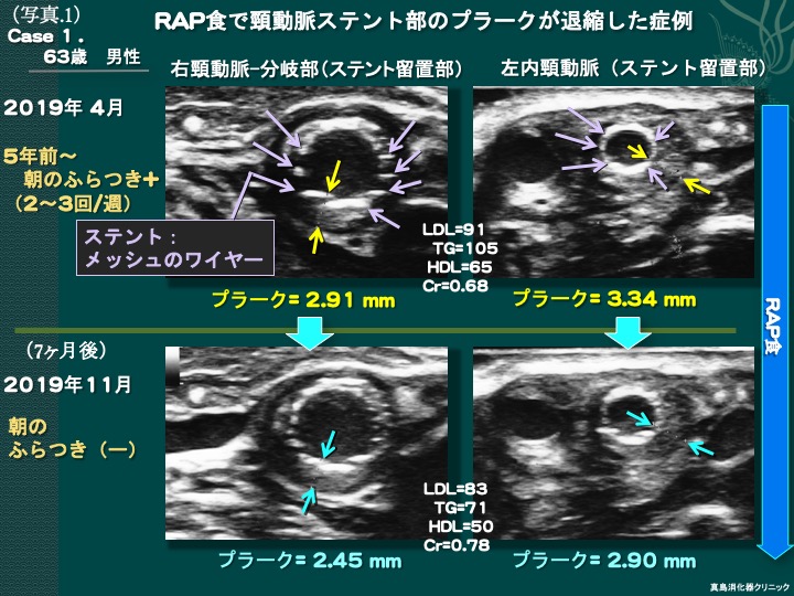 頸動脈ステント留置術と頸動脈内膜切除術の違いは何ですか?